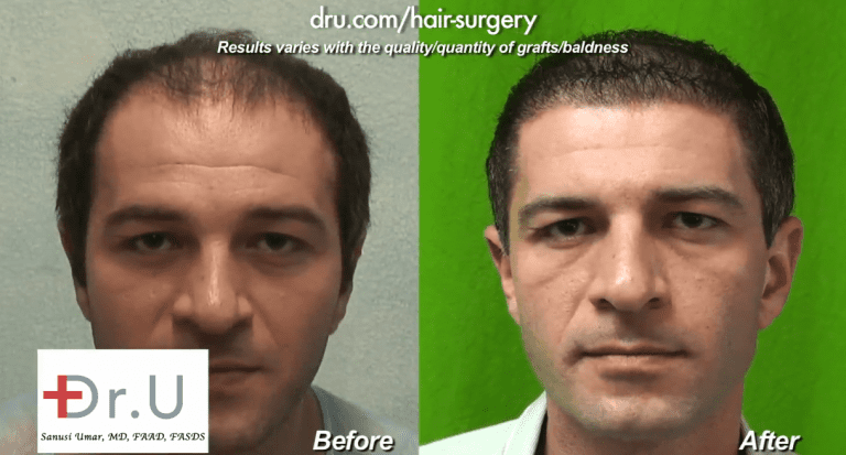 The Dr.UGraft's thinning hair transplant results shown in the crown and top of the scalp The Dr.UGraft's thinning hair transplant results shown in the crown and top of the scalp