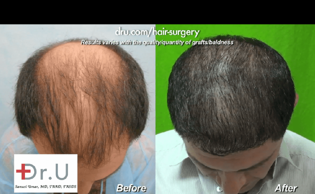 Before and after photos of thinning hair transplant results shown on patient's top scalp Before and after photos of thinning hair transplant results shown on patient's top scalp