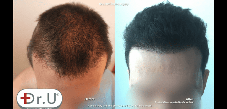 Patient from Venice Beach, Los Angeles now has normal looking hair growth patterns on the top of his head Patient from Venice Beach, Los Angeles now has normal looking hair growth patterns on the top of his head