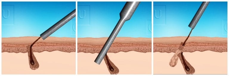 The angle of body hair tends to change below the skin's surface. Because of this, regular FUE punches are more likely to cut straight through the graft The angle of body hair tends to change below the skin's surface. Because of this, regular FUE punches are more likely to cut straight through the graft