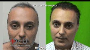Most patients will be able to enjoy their final results after a hair transplant around eighteen months following their surgery Most patients will be able to enjoy their final results after a hair transplant around eighteen months following their surgery