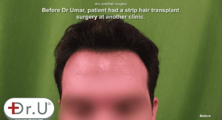 Venice Beach patient is unhappy with his receded hairline and temples Venice Beach patient is unhappy with his receded hairline and temples