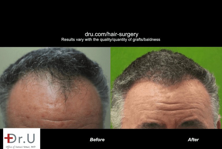 Patient is happy with his conservative hair transplant outcome which advanced his receded hairline and temples to produce a natural-looking improvement Patient is happy with his conservative hair transplant outcome which advanced his receded hairline and temples to produce a natural-looking improvement
