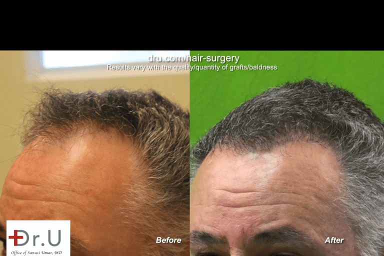 Closeup view of mature hairline and corresponding temple points, before and after surgery Closeup view of mature hairline and corresponding temple points, before and after surgery