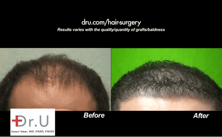 Beverly Hills patient was able to achieve an aggressive low hairline after his Dr.UGraft procedure Beverly Hills patient was able to achieve an aggressive low hairline after his Dr.UGraft procedure