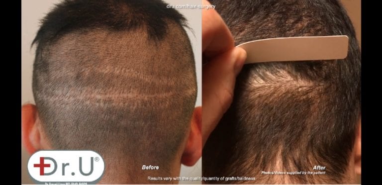 Close up view of the Dr.UGraft™ strip scar repair. No noticeable signs of scarring can be seen even as a piece of cardboard runs through the back of the head Close up view of the Dr.UGraft™ strip scar repair. No noticeable signs of scarring can be seen even as a piece of cardboard runs through the back of the head