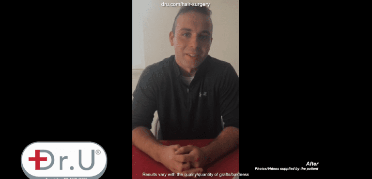 Manhattan Beach patient is happy with his decision to undergo an early 20's hair transplant with Dr.UGraft™ technology Manhattan Beach patient is happy with his decision to undergo an early 20's hair transplant with Dr.UGraft™ technology
