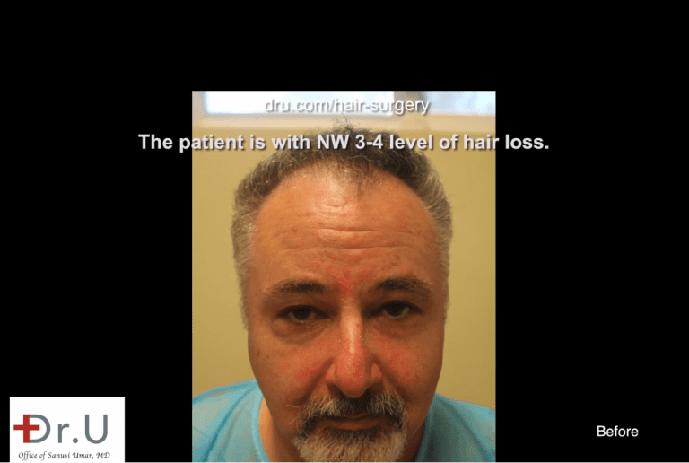 Redondo Beach patient before his Norwood 4 hair transplant Redondo Beach patient before his Norwood 4 hair transplant