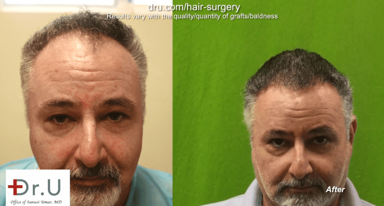Patient is happy with the way his Norwood 4 hair transplant energized his overall appearance, while maintaining an age-appropriate look Patient is happy with the way his Norwood 4 hair transplant energized his overall appearance, while maintaining an age-appropriate look