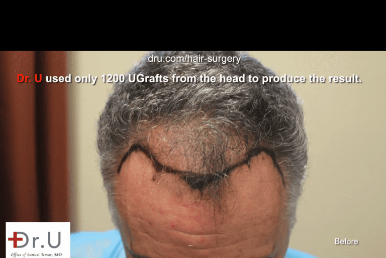 Dr. Umar designed a hairline and temples to create a most natural looking hair transplant outcome. Dr. Umar designed a hairline and temples to create a most natural looking hair transplant outcome.