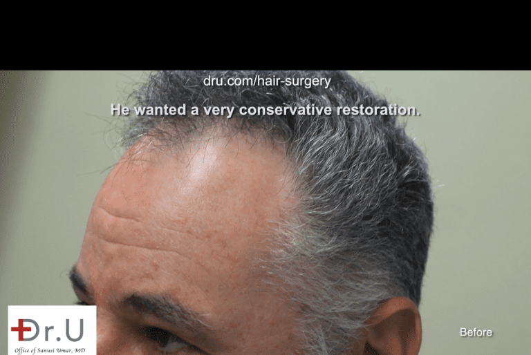 Patient wants the look of a mature hairline that is appropriate for his age Patient wants the look of a mature hairline that is appropriate for his age