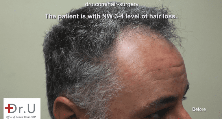 Side view of patient showing receded temples. He hopes to achieve a conservative hair transplant outcome Side view of patient showing receded temples. He hopes to achieve a conservative hair transplant outcome