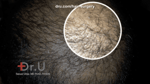 In the initial stages of hair transplant growth, around the third to fourth month, patients may start to notice pimple-like bumps, which actually is a positive sign of new growth In the initial stages of hair transplant growth, around the third to fourth month, patients may start to notice pimple-like bumps, which actually is a positive sign of new growth
