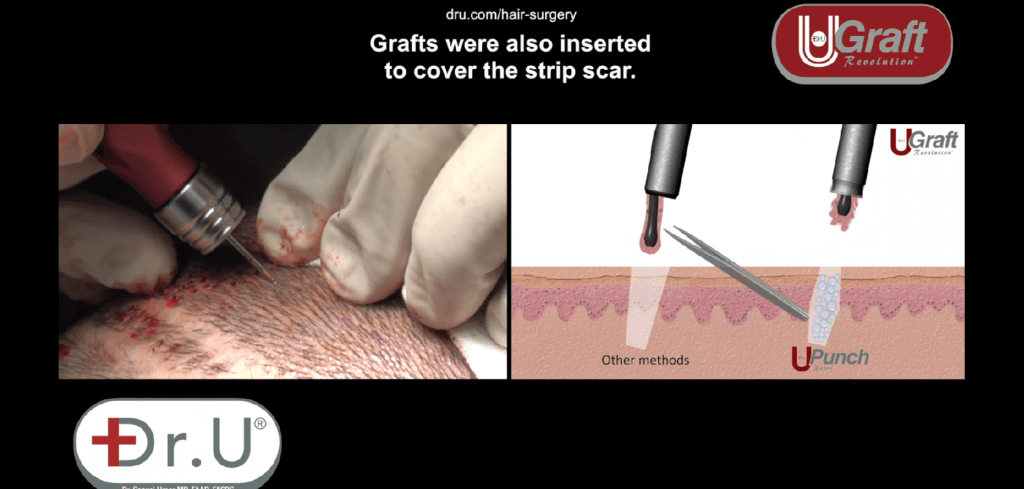 Beverly Hills patient before and after his Dr.UGraft receding hairline surgery before and after Beverly Hills patient before and after his Dr.UGraft receding hairline surgery before and after