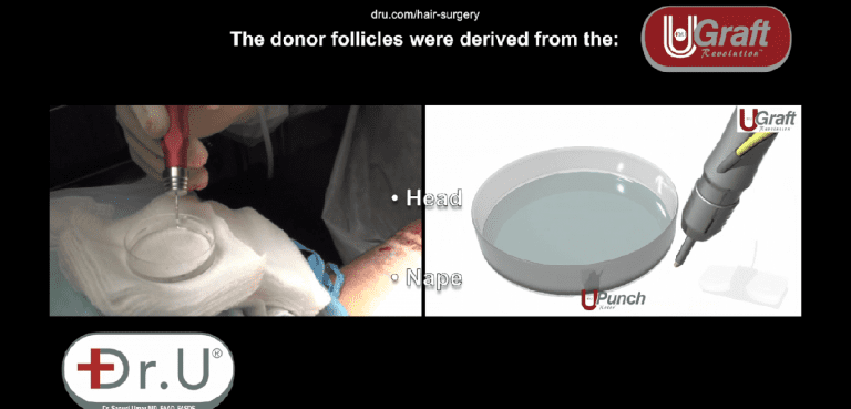 Dr.UGraft™ technology uses fluid irrigation to hydrate grafts right when they are being extracted to prevent them from being exposed to the air Dr.UGraft™ technology uses fluid irrigation to hydrate grafts right when they are being extracted to prevent them from being exposed to the air