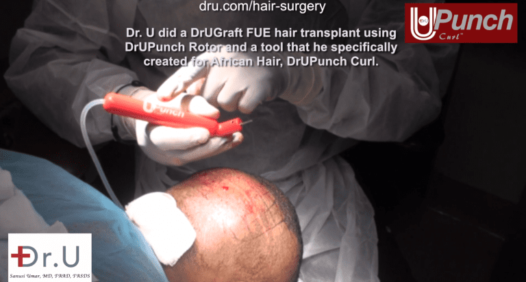 Dr. Umar performs a traction alopecia treatment on Santa Monica patient, using his device the Dr.UPunch Curl Dr. Umar performs a traction alopecia treatment on Santa Monica patient, using his device the Dr.UPunch Curl