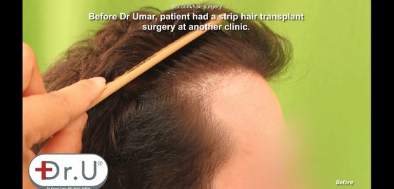 Patient shows pluggy appearance along the edge of his hairline and temples Patient shows pluggy appearance along the edge of his hairline and temples