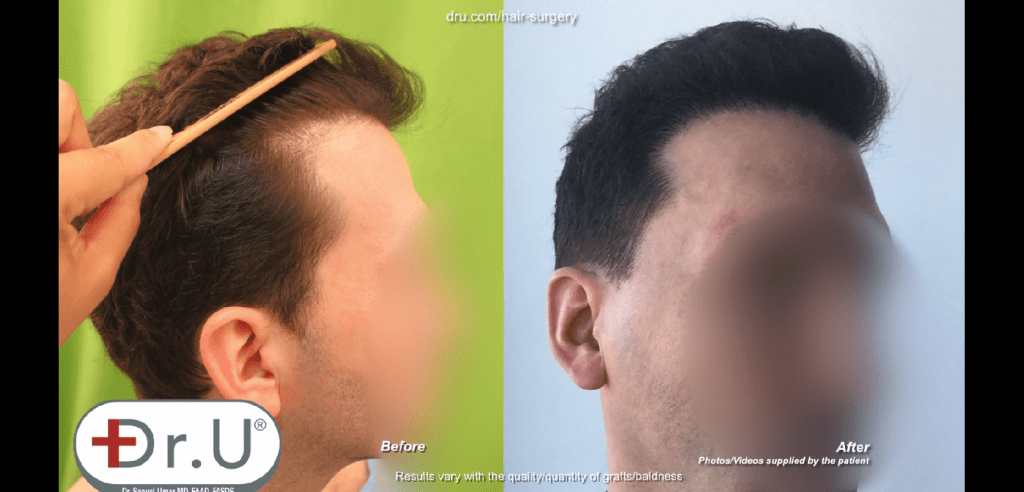 The Dr.UGraft solution for receding hairline helped turn the clock back for this patient, while producing very natural looking results The Dr.UGraft solution for receding hairline helped turn the clock back for this patient, while producing very natural looking results