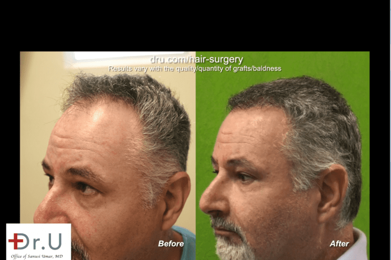 Side view of Redondo Beach patient before and after his Norwood 4 hair transplant Side view of Redondo Beach patient before and after his Norwood 4 hair transplant