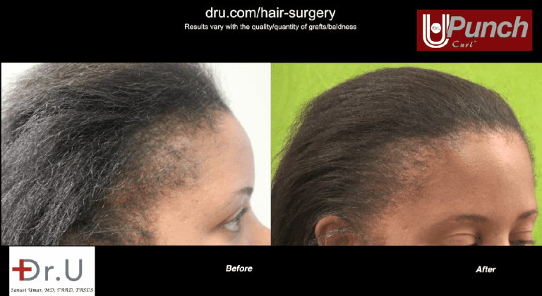 Traction alopecia prevention and treatment: This patient had abused her hair for years with braids, weaves, and tight ponytails. She later underwent the Dr.UGraft procedure to restore her hair. Traction alopecia prevention and treatment: This patient had abused her hair for years with braids, weaves, and tight ponytails. She later underwent the Dr.UGraft procedure to restore her hair.