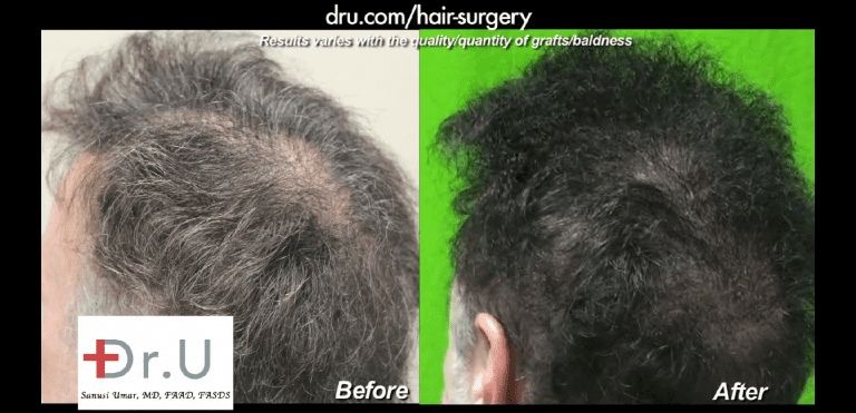 3000 beard hair grafts produced an incredible slot deformity repair outcome 3000 beard hair grafts produced an incredible slot deformity repair outcome