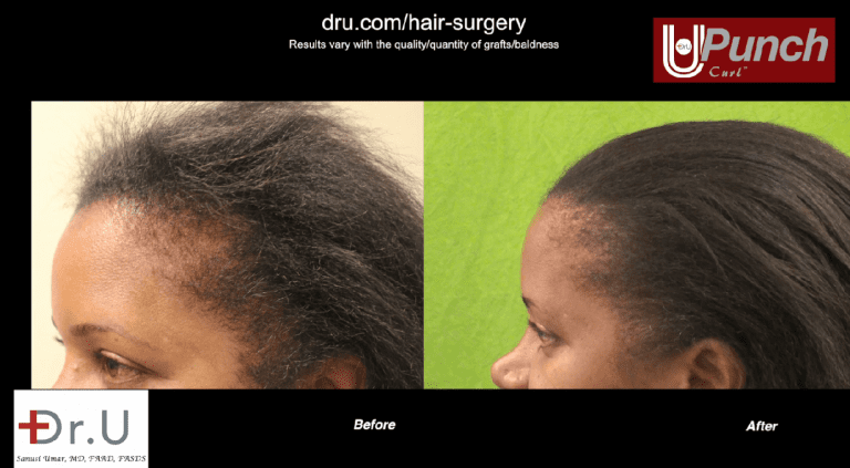 Image of black female hair transplant before and after her edges restoration surgery with the Dr.UPunch Curl. Image of black female hair transplant before and after her edges restoration surgery with the Dr.UPunch Curl.