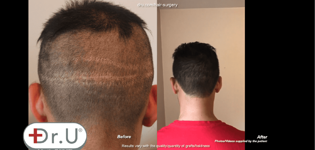 The Dr.UGraft solution for a receding hairline also addressed the temples to produce the results shown * The Dr.UGraft solution for a receding hairline also addressed the temples to produce the results shown *