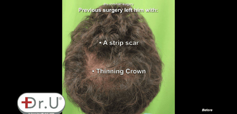 Before his Dr.UGraft™ patient's crown area shows transplanted hair not growing Before his Dr.UGraft™ patient's crown area shows transplanted hair not growing