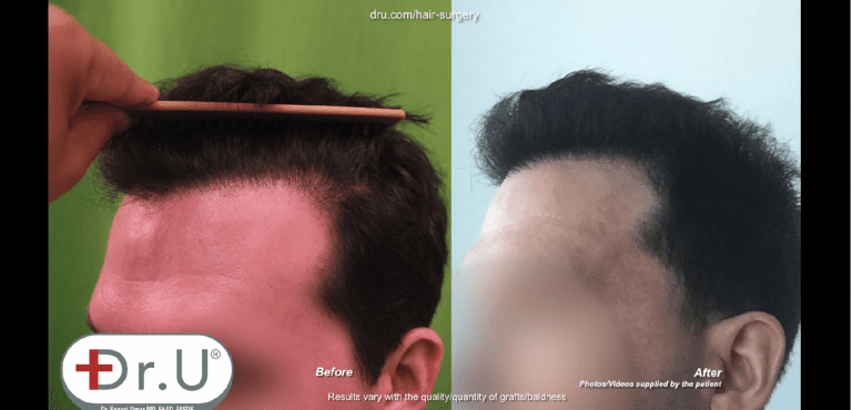 Patient no longer has plugginess along his hairline thanks to Dr. Umar Patient no longer has plugginess along his hairline thanks to Dr. Umar