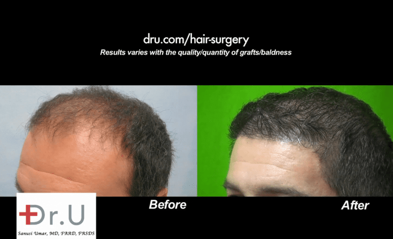 Dr. Umar was able to correct this patient's depleted hairline and temples Dr. Umar was able to correct this patient's depleted hairline and temples