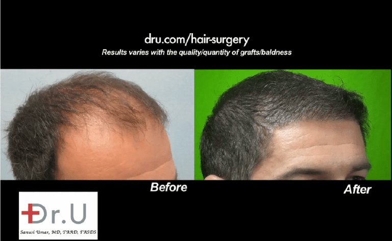 Patient's hairline and temples shown from the right side Patient's hairline and temples shown from the right side
