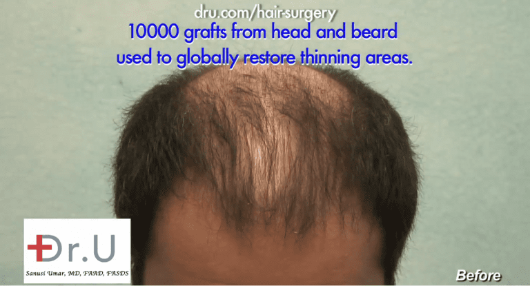 Top part of scalp shows severe thinning instead of complete hair loss Top part of scalp shows severe thinning instead of complete hair loss