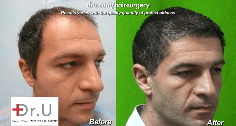 The addition of beard hair to this patient's donor pool helped him regain a younger looking appearance The addition of beard hair to this patient's donor pool helped him regain a younger looking appearance