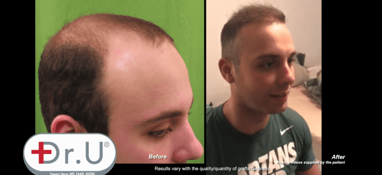 Profile view of Manhattan Beach patient who achieved the results he wanted from his early 20's hair transplant Profile view of Manhattan Beach patient who achieved the results he wanted from his early 20's hair transplant