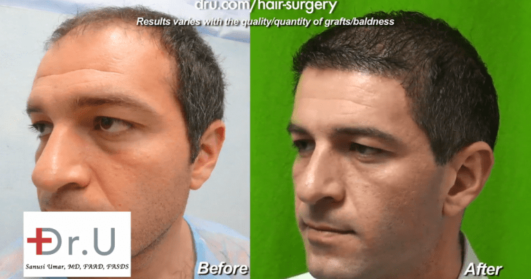 With a 10,000 grafts hair transplant, this patient achieved amazing coverage and a youthful low hairline With a 10,000 grafts hair transplant, this patient achieved amazing coverage and a youthful low hairline
