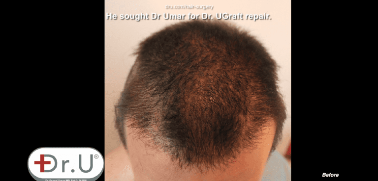 Patient hope to undo hair transplant results on the top of his head Patient hope to undo hair transplant results on the top of his head