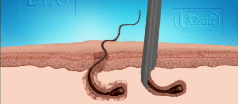 The Dr. UPunch Curl is an excellent choice for black females interested in undergoing edges restoration surgery The Dr. UPunch Curl is an excellent choice for black females interested in undergoing edges restoration surgery