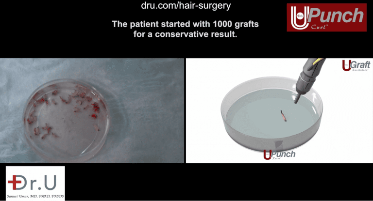 The Dr. UPunch Curl can be attached to a fluid irrigation system to produce healthier, hydrated grafts. This increases the likelihood of traction alopecia regrowth following a Dr.UGraft restoration procedure. The Dr. UPunch Curl can be attached to a fluid irrigation system to produce healthier, hydrated grafts. This increases the likelihood of traction alopecia regrowth following a Dr.UGraft restoration procedure.