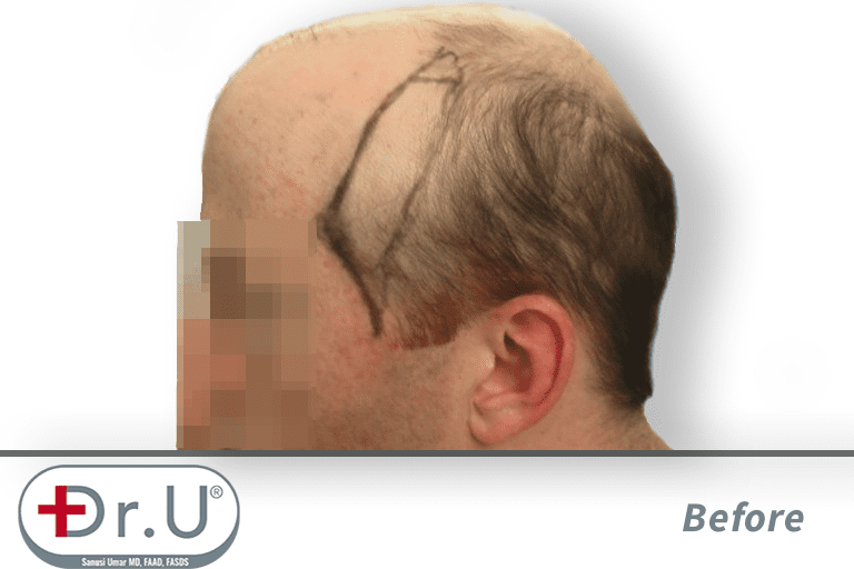 Advancement of the temples marked on the patient’s scalp. This is a necessary aspect of his hair transplant and hairpiece combination Advancement of the temples marked on the patient’s scalp. This is a necessary aspect of his hair transplant and hairpiece combination