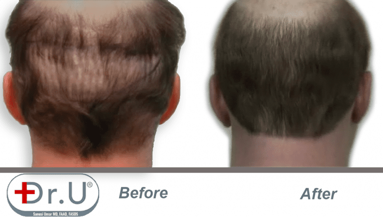 Before and after view of scalp donor area which was repaired with body hair grafts. Filling in this area was one of the goals of the patient's hair transplant repair for hairpiece integration. Before and after view of scalp donor area which was repaired with body hair grafts. Filling in this area was one of the goals of the patient's hair transplant repair for hairpiece integration.