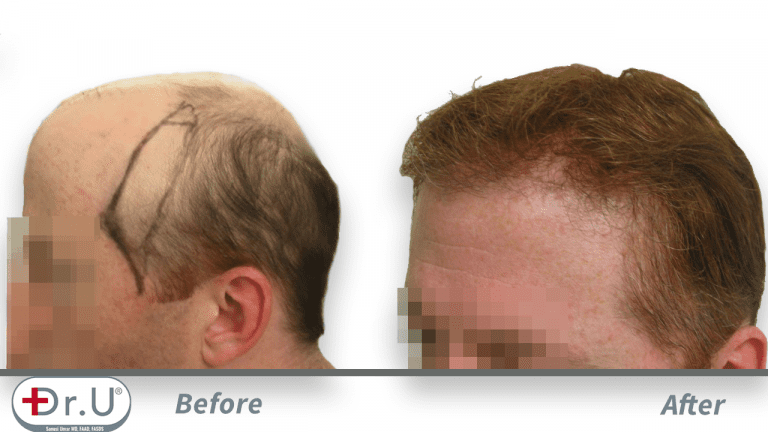 Redondo Beach patient depicted from the side, before and after his Dr.UGraft hair transplant repair for hairpiece integration. Redondo Beach patient depicted from the side, before and after his Dr.UGraft hair transplant repair for hairpiece integration.