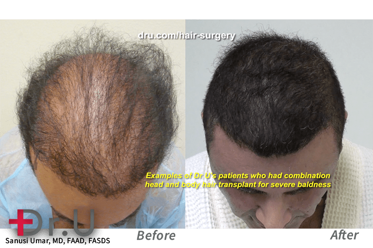 This patient lacked sufficient head donor grafts for sufficient coverage from a hair transplant. Dr. Umar was able to harvest additional grafts from body areas in order to meet this patient's higher graft count.