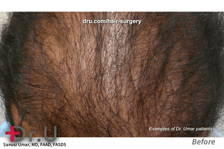 The patient above came to Dr. U with sparse growth from a previous procedure. Other clinics struggle to provide the necessary grafts for dense results. To avoid these results, Dr. Umar augments donor supply with body hair grafts using the Intelligent Punch (Dr.UPunch i).