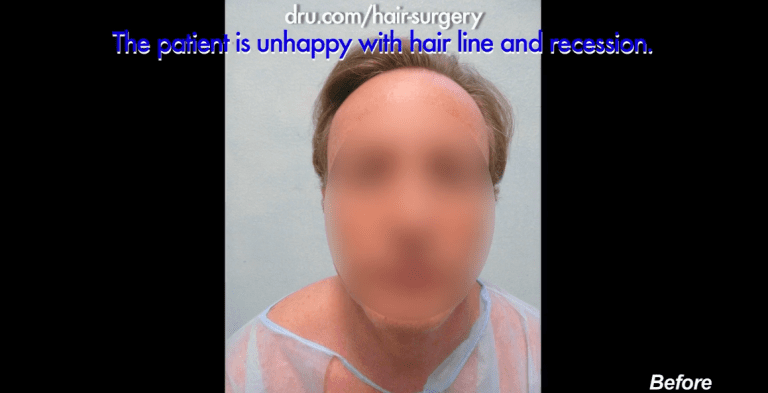 Patient before his Dr.UGraft solution for a receding hairline. Patient before his Dr.UGraft solution for a receding hairline.