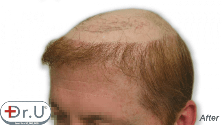 Many men are interested in a combination of hair transplant and hairpiece to achieve the coverage they want. This photo shows a three-quarters facial view showing the patient's hairline temples created for his hairpiece. Many men are interested in a combination of hair transplant and hairpiece to achieve the coverage they want. This photo shows a three-quarters facial view showing the patient's hairline temples created for his hairpiece.