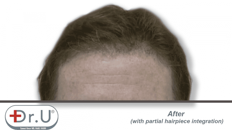 Final results showing patient's partial hairpiece integration with the hairline and temples created during his Dr.UGraft procedure. Final results showing patient's partial hairpiece integration with the hairline and temples created during his Dr.UGraft procedure.