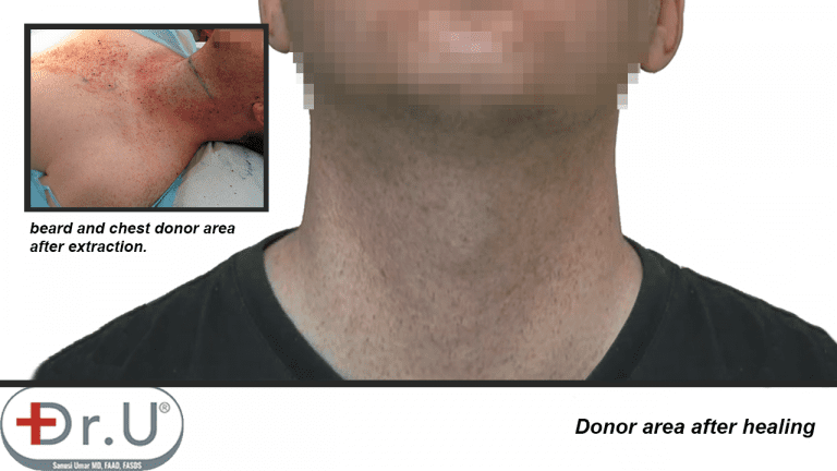 Beard region on patient's face and neck healed without noticeable signs of redness or scarring, following his hair transplant and hairpiece combination surgery using Dr.UGraft technology. Beard region on patient's face and neck healed without noticeable signs of redness or scarring, following his hair transplant and hairpiece combination surgery using Dr.UGraft technology.