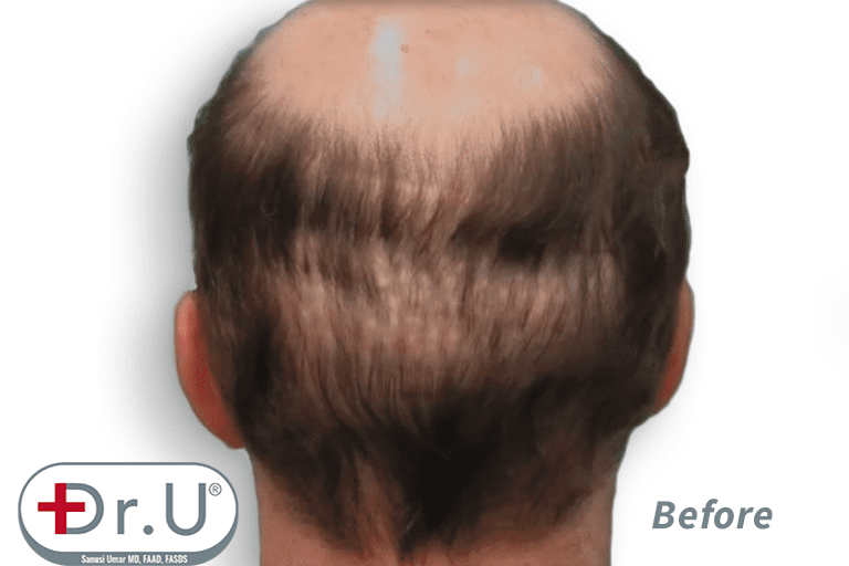 Patient hopes for a hair transplant and hairpiece combination result, as well as to fill in the depleted donor area on the back of his head Patient hopes for a hair transplant and hairpiece combination result, as well as to fill in the depleted donor area on the back of his head