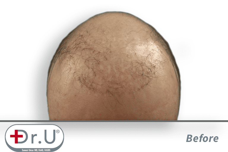 Redondo Beach patient before his Dr.UGraft hair piece integration surgery Redondo Beach patient before his Dr.UGraft hair piece integration surgery