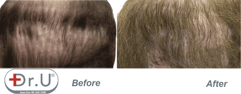 Close up view showing final results of repair where body hair grafts were used to fill in the patient's depleted donor region on his scalp. Close up view showing final results of repair where body hair grafts were used to fill in the patient's depleted donor region on his scalp.